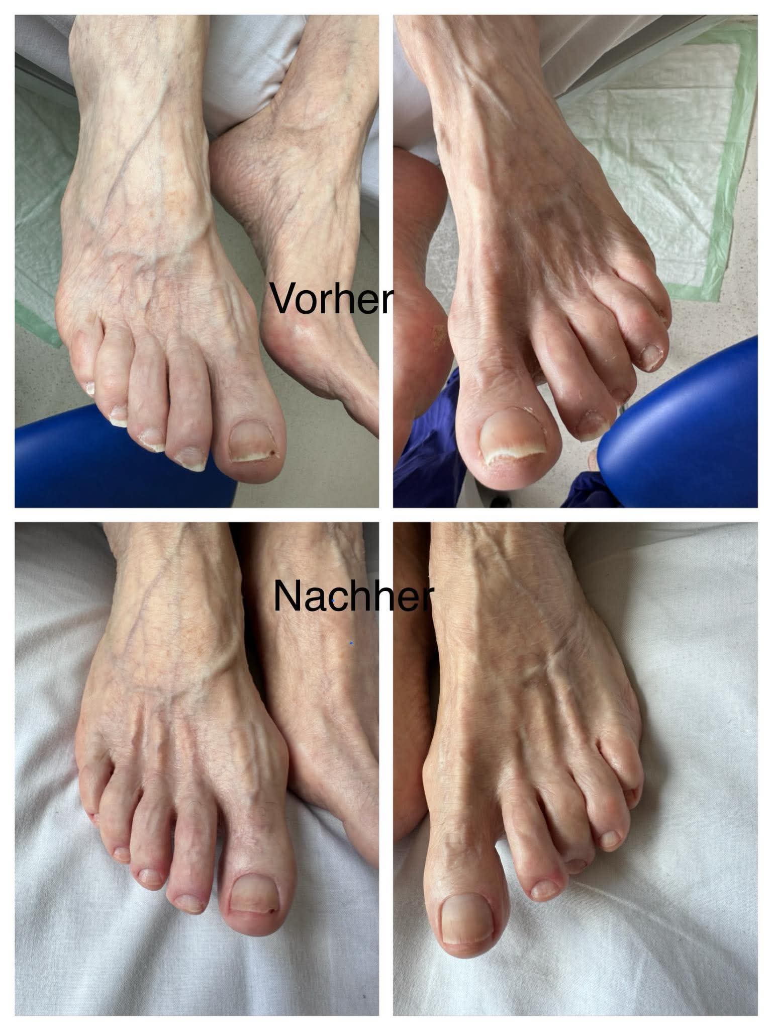 Beispiel einer Fußpflege vor und nach der Behandlung